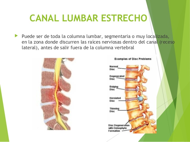 الانزلاق الغضروفي .. أسبابه وطرق علاجه
